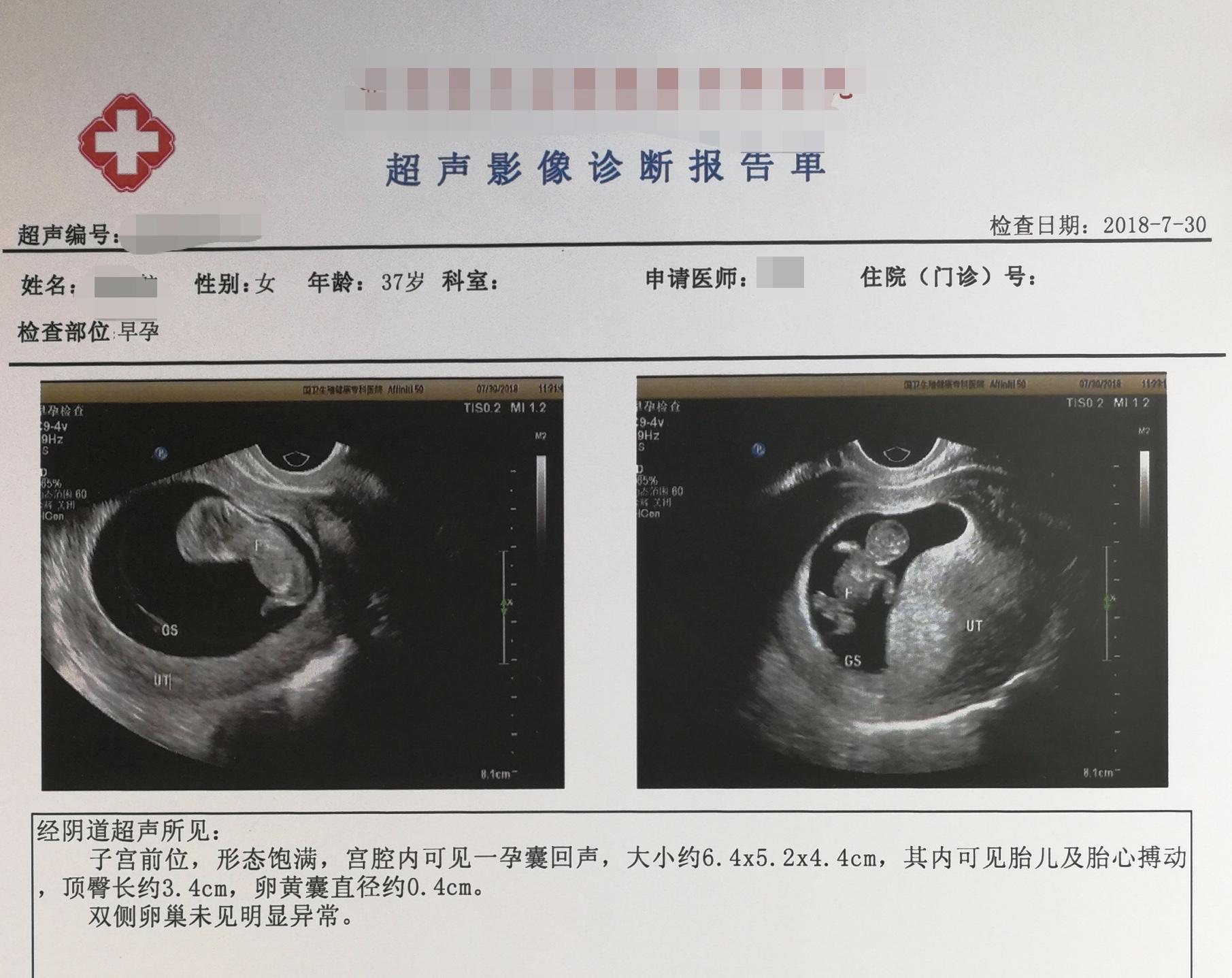 2018年7月A小滾珠的診斷報告C肚子裡的孩子第一次有了清晰的人形C受訪者供圖
