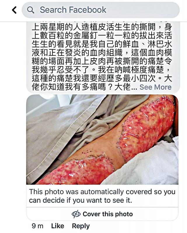 被淋鏹警向同袍哭訴換皮之苦�A聞者心酸�C網上圖片