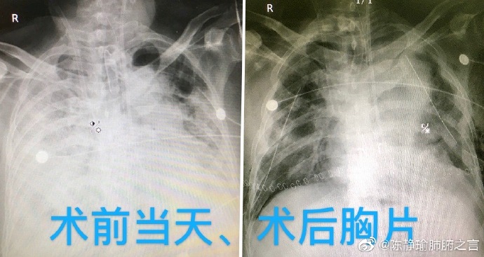 肺移植專家陳靜瑜教授微博圖