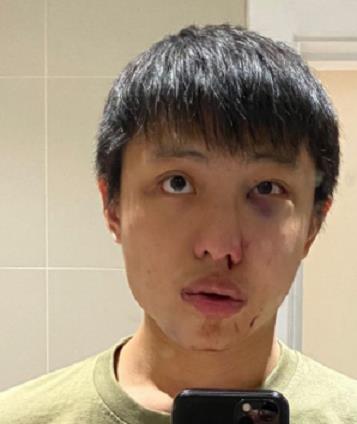 Jonathan Mok在英國被打至鼻青臉腫(網絡圖片)