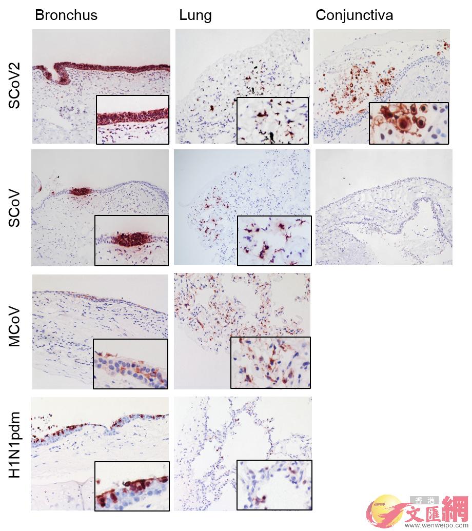 人類呼吸道同眼外植體中的新冠病毒感染細胞 圖片來源G香港大學新聞中心